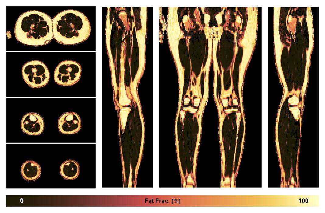 The fat fraction of the lower extremity obtained from the dixon reconstruction for muscle water fat quantification.